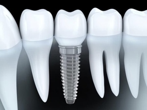 Implantologie et Omnipratique H/F